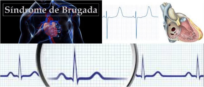 Síndrome de Brugada: ¿Cómo es la enfermedad que padece Carla Barber?