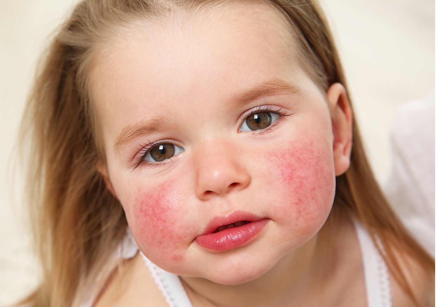 Dermatitis atópica: Descubre sus factores de riesgo y complicaciones niña con Dermatitis atópica