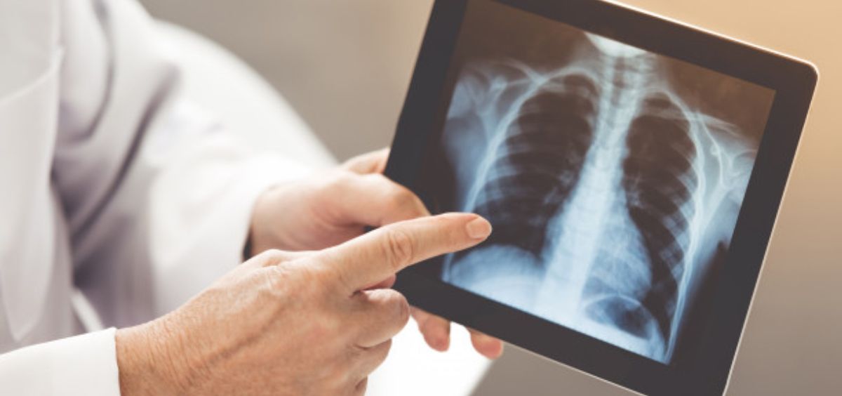 Neumonía bilateral: Causas, síntomas y complicaciones Neumonía bilateral